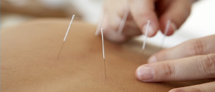 acupuncture-treatment